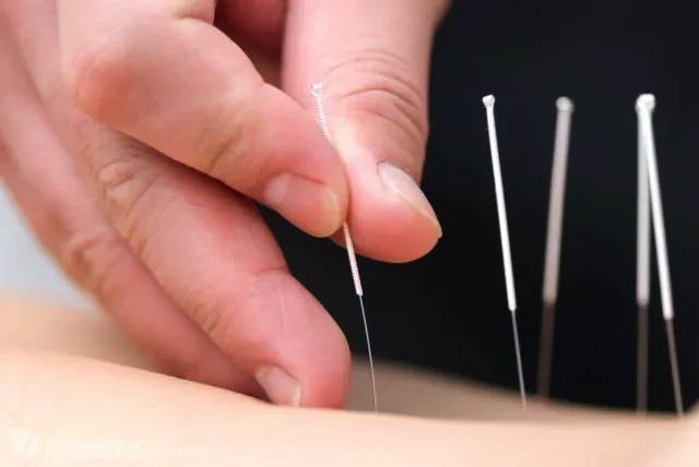 acupuncture at cure by nature